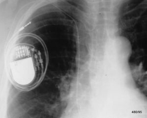 Pacemaker Lead Displacement